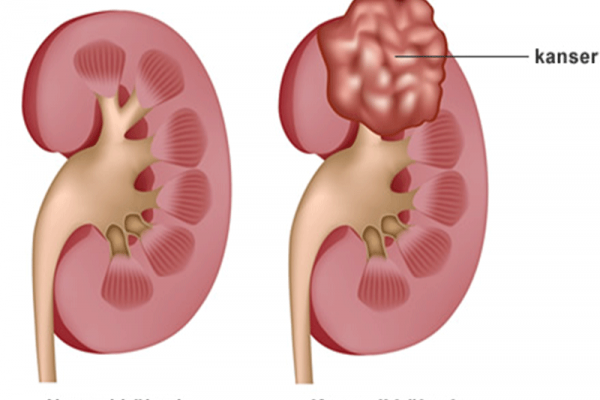 Böbrek ve Üreter Hastalıkları